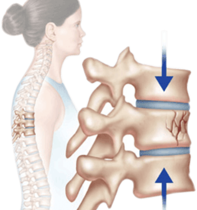 Best Spine Fracture Treatment in Ahmedabad