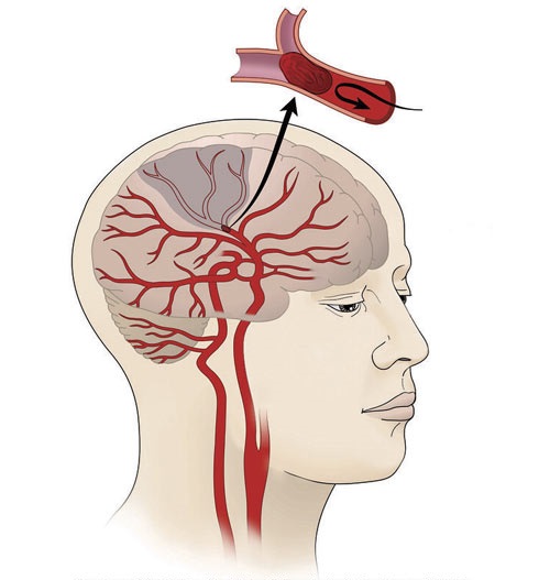 Best Stroke Treatment in Ahmedabad