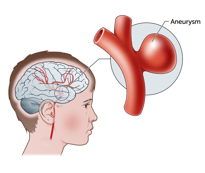 Brain Aneurysm Treatment in Ahmedabad