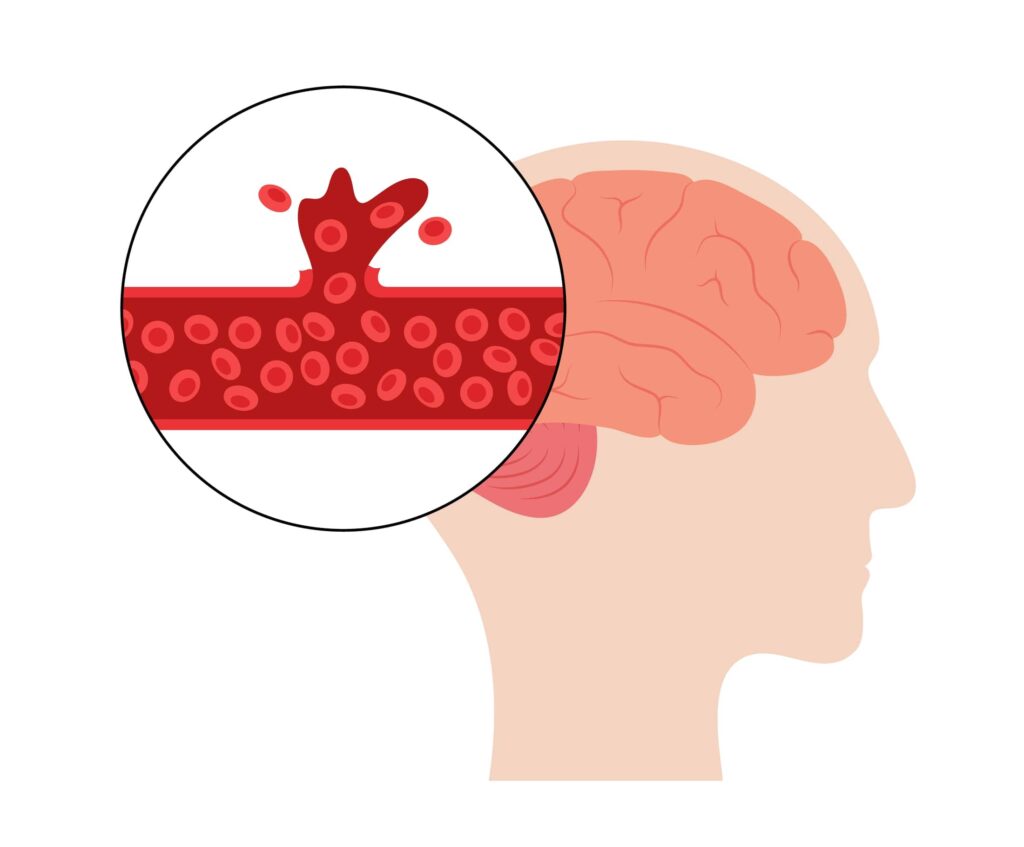 Brain Hemorrhage Treatment in Ahmedabad