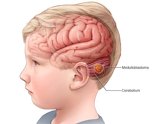 Brain Tumor Surgery in Ahmedabad