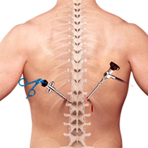 MIS Spine surgeon in Ahmedabad