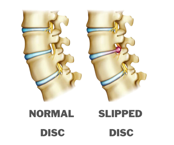 Best Slip Disc Treatment in Ahmedabad