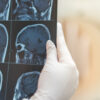 Brain Tumor Specialist in Ahmedabad
