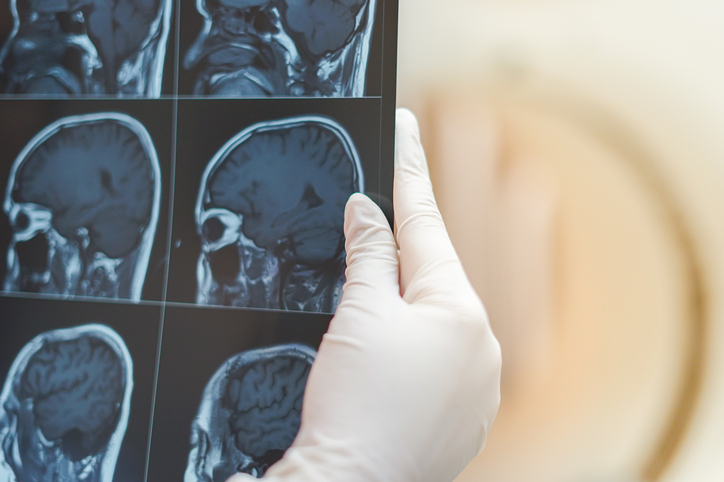 Brain Tumor Specialist in Ahmedabad